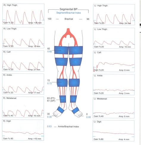 Pulse Volume Recordings (PVR): Indications and How .